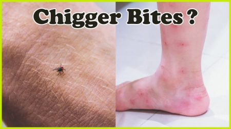 How To Get Rid Of Chiggers X Pest   How To Get Rid Of Chiggers 4 450x253 